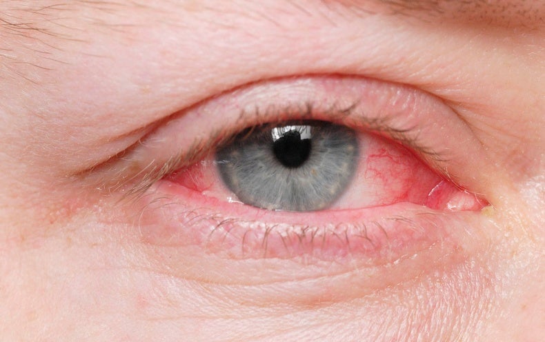 What Is Producing So Much Pink Eye?