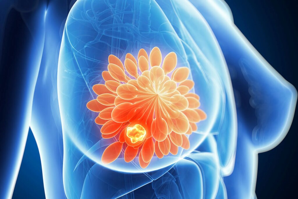 Some Breast Most cancers Individuals May well Properly Forgo Chemotherapy