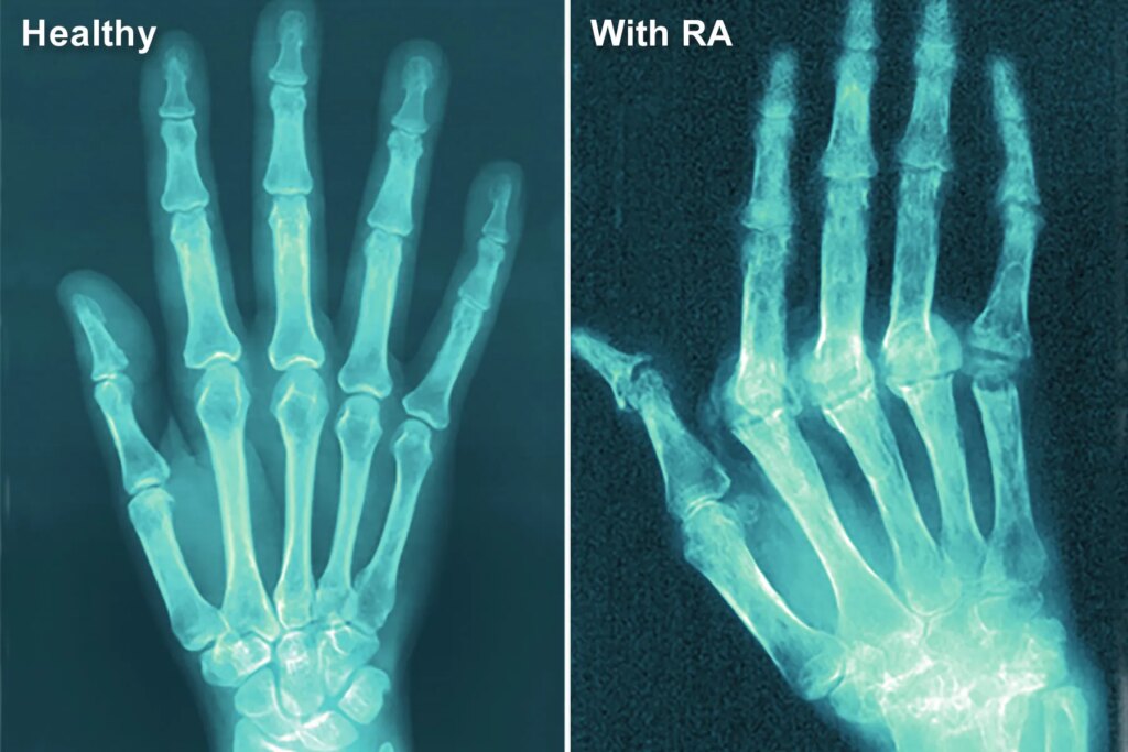 Fda Warns of Hidden Substances in Arthritis, Soreness Items