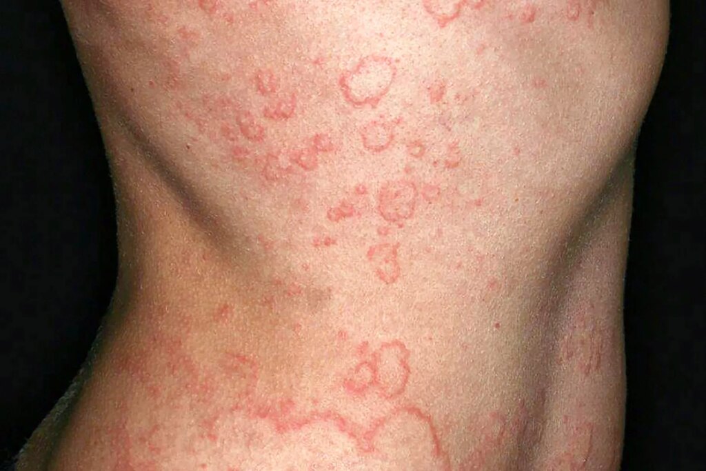 Serious Spontaneous Urticaria: What to Know