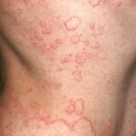 Serious Spontaneous Urticaria: What to Know