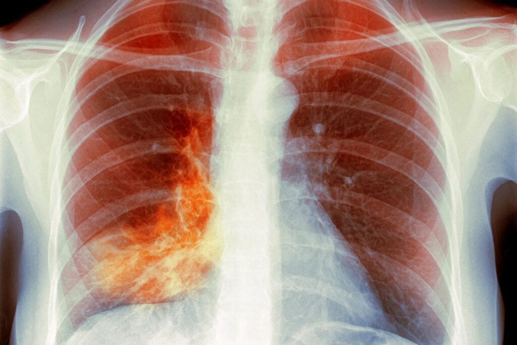 ‘White Lung’ Pneumonia – What You Will need to Know