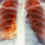 ‘White Lung’ Pneumonia – What You Will need to Know