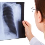 Lung Cancer in Women Who Never Smoked